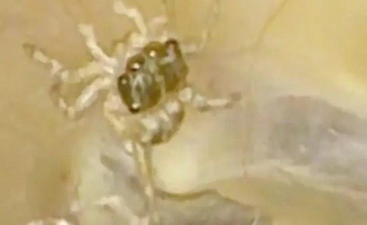 Creepy surprise: Woman discovers live spider molting in her ear